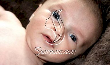 اسباب وعلاج صفار العين للاطفال الرضع