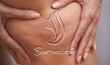 نصائح للقضاء على الـسيلوليت