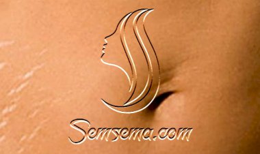 تخلصي من خطوط البطن الناتجة عن الحمل بسهولة