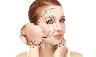 نصائح سهلة للعناية بالبشرة الدهنية