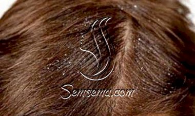 طريقة سهلة للتخلص من قشرة الشعر