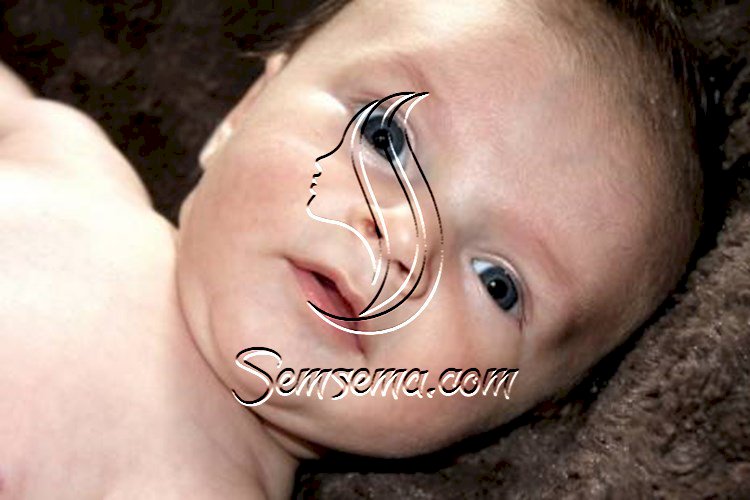 اسباب وعلاج صفار العين للاطفال الرضع